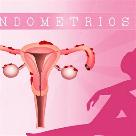 endometriosis specialist mumbai dr neelima mantri