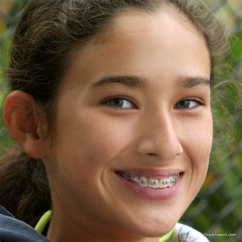 60 Photos Of Teenagers With Braces Robweigners Blog