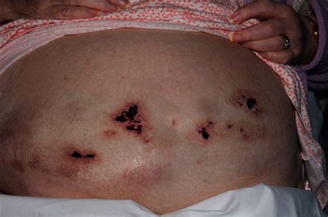 Delayed Onset Heparin Induced Skin Necrosis A Rare Complication Of