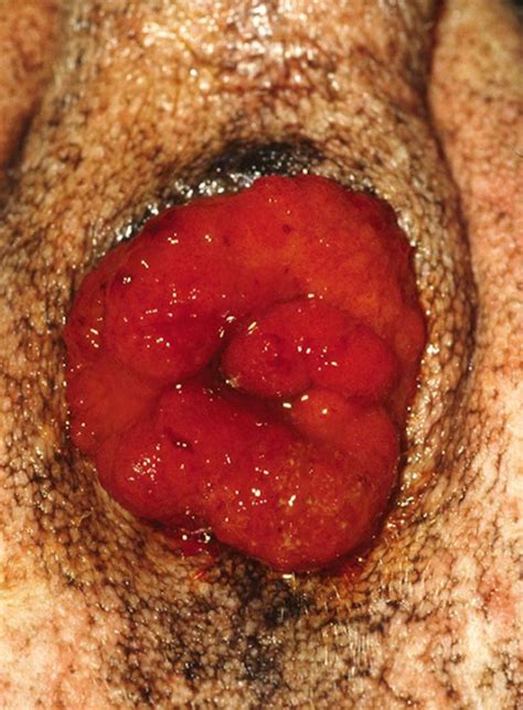 rectum prolapse surgical management in canis vetlexicon