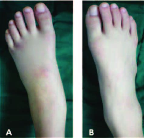 These Picture Show Swelling Of Left Ankle Joint A And Normal Right