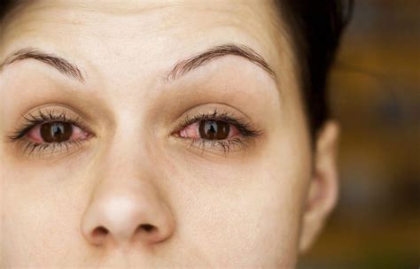 Burning Eyes Causes Symptoms And Treatment