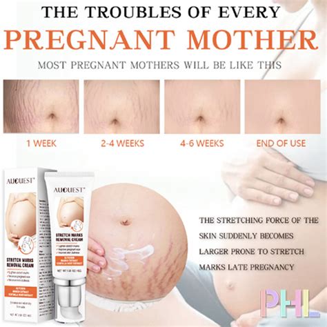 Phl Stretch Mark Remover Stretchmark Removal Cream Stretch Marks