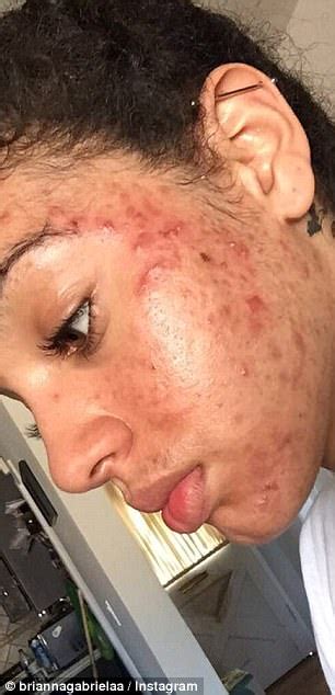 girl cleared her acne with health food store products daily mail online
