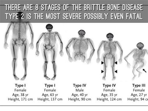 Osteogenesis Imperfecta Type 8