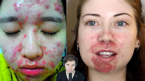 video girls with severe acne before and after cysts scars