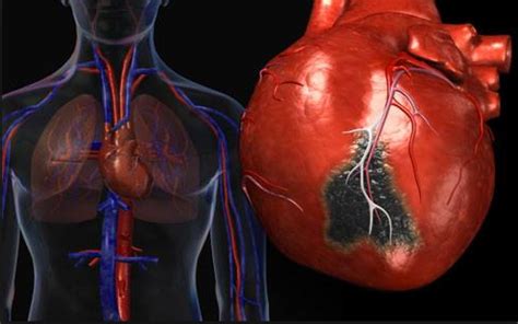 heart disease balitang viral