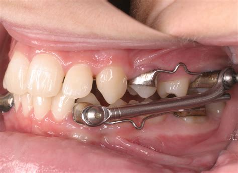 soorten beugels orthodontie zwielich