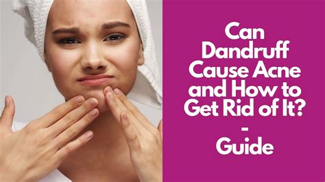 Can Dandruff Cause Acne And How To Get Rid Of It Guide