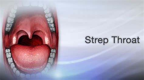 Strep Throat Symptoms Causes Diagnosis And More