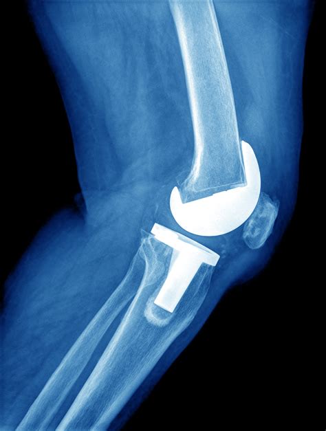 knee replacement  ray