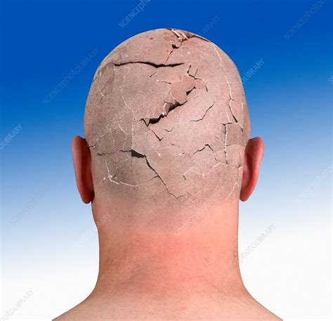 person  cracked head illustration stock image  science photo library