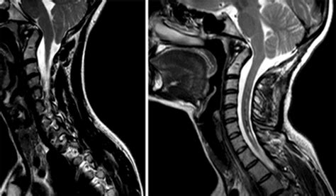 Chiari I Malformation With And Without Basilar Invagination A