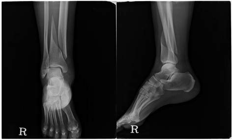 normal left ankle xray