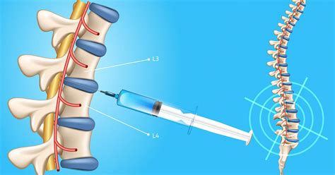 lumbar puncture seattle wa brain  spine surgery