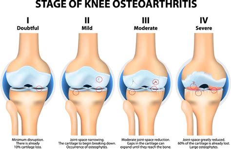 knee osteoarthritis  knees hurt    oa pt health