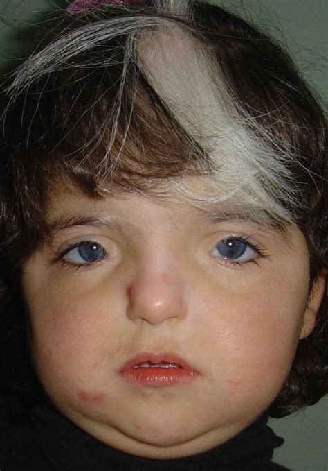 waardenburg syndrome symptoms pictures   treatment