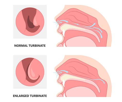 treatment  nasal turbinate hypertrophy  high frequency curis technique  fv safe