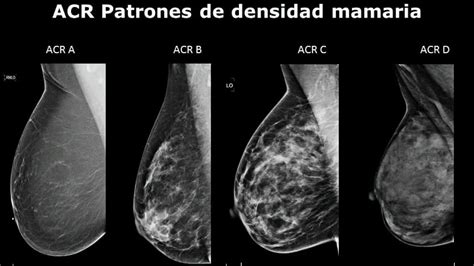 tipos de cancer de mama seo positivo