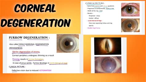 corneal degeneration classification symptoms treatment