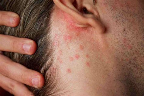 stress skin rash  triggers breaking latest news