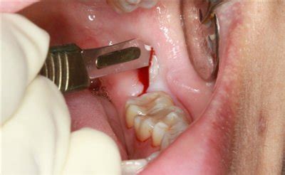infection  gum  tooth removal iytmedcom