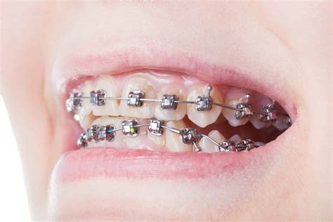 dental steel brackets  teeth close  mary cay koen