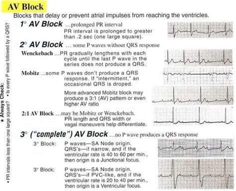 conduction blocks   av node av blocks  examples manual  medicine