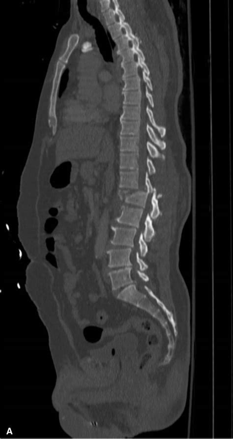 Vertebrae And Spinal Cord Trauma 7th Ed