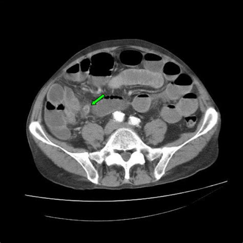 acute appendicitis presenting  small bowel obstruction
