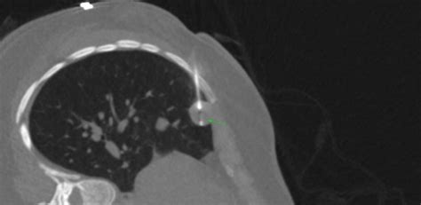 lung nodules   mm ct guided biopsy