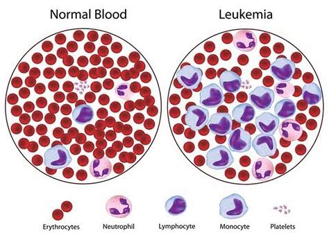 leukemia symptoms types and risk factors daneelyunus
