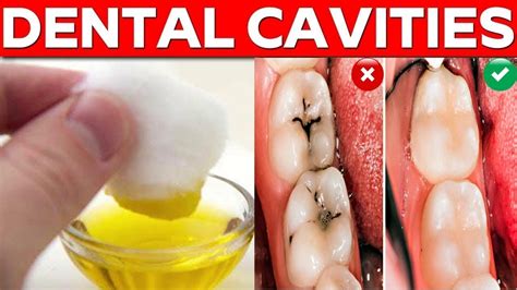 cure teeth cavities naturally  home  rid  dental