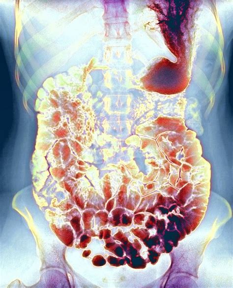 Large Intestine X Ray Photograph By Du Cane Medical Imaging Ltd Pixels