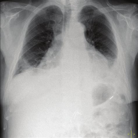 Patient Chest X Ray On Admission Showing A Bilateral Pleural Effusion