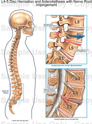 disc herniation  anterolisthesis  nerve root impingement medical illustration