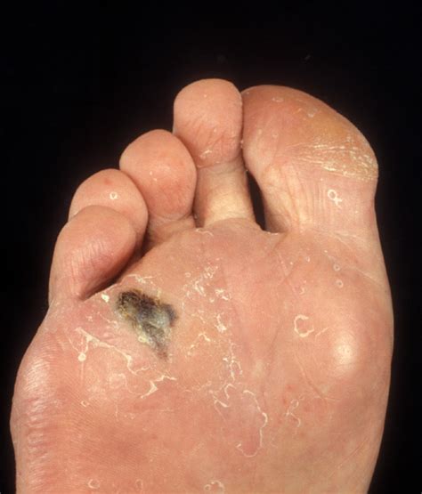 What Are The Different Types Of Malignant Melanoma Northpointe Foot