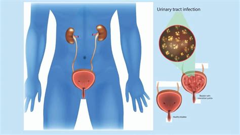 urinary tract infection causes symptoms and long term outlook 1md