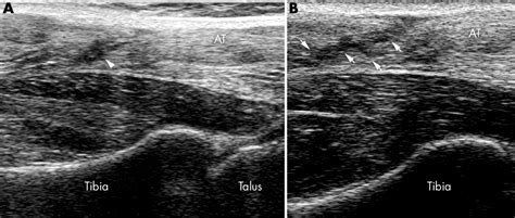 partial rupture of the proximal achilles tendon a differential