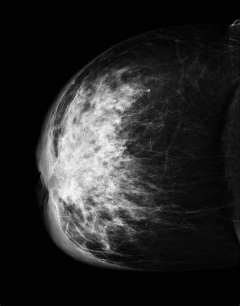 inflammatory breast carcinoma image