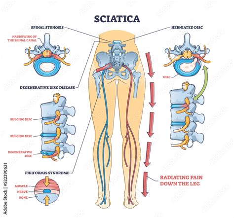 wall mural disease vertebra sciatica pain  nerve weakness  leg