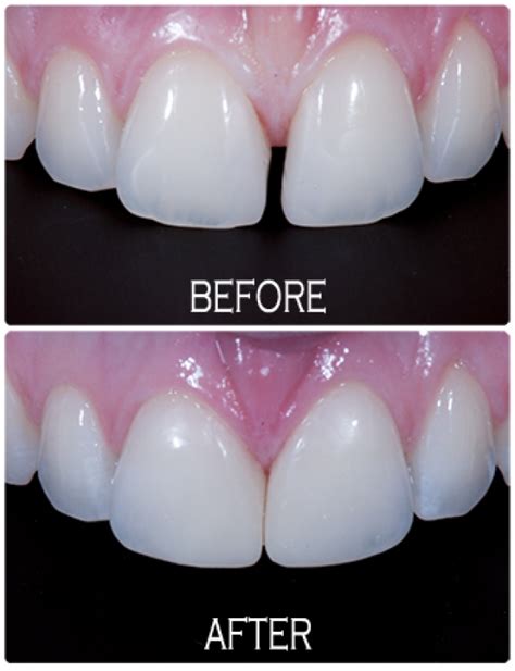 tooth coloured resins kaleen dental care facial aesthetics