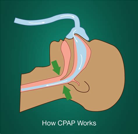 treat sleep apnea  cpap therapy soclean sleep talk blog