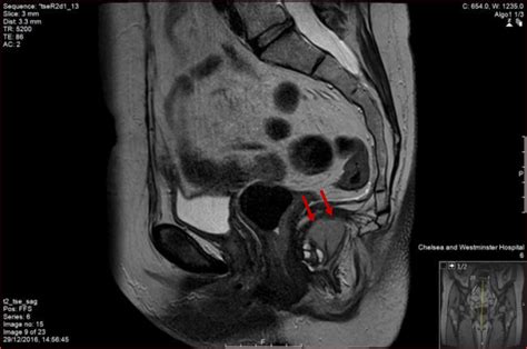 an unusual rectal duplication cyst surgical case reports full text