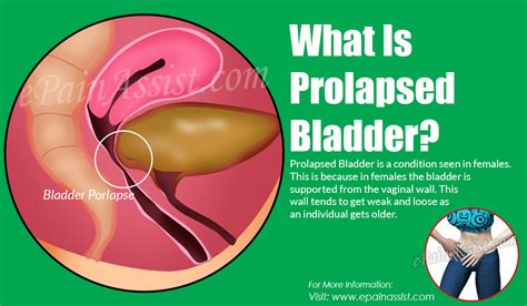 Prolapsed Bladder Stages Causes Symptoms Treatment And Surgery