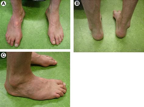significant forefoot varus deformity resulting  progressive stress fractures   lesser