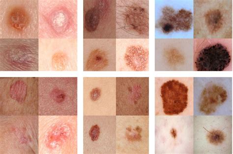 start campagne huidkanker hoe ziet je huid er echt uit stichting onzichtbaar ziek