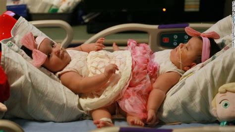 conjoined sisters undergo rare separation surgery in texas q13 fox news