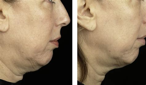 thermage   surgical face lifts   tighten loose skin     choice  tighten