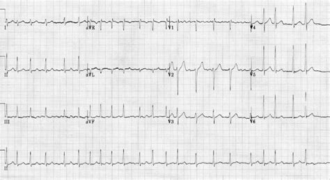 Atrial Fibrillation Litfl Ecg Library Diagnosis 57528 Hot Sex Picture